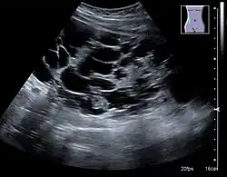 Advanced polycystic kidney disease with multiple cysts.[13]