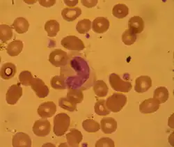 Band neutrophil in peripheral blood film
