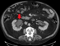 CT scan of bilateral hydronephrosis due to a bladder cancer