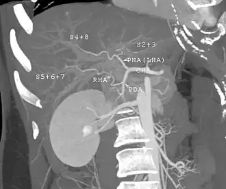 MDCT image. Arterial anatomy contraindicated for liver donation