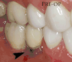 When the metal of an implant becomes visible a connective tissue graft is used to improve the mucosal height.