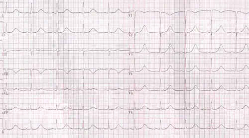Long QT syndrome