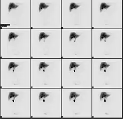 Normal hepatobiliary scan (HIDA scan). The nuclear medicine hepatobiliary scan is clinically useful in the detection of the gallbladder disease.
