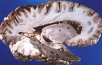 Human brain right dissected lateral view