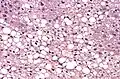 Histological section of a mouse's liver showing severe steatosis. The clear vacuoles contained lipid in life; however, histological fixation caused it to be dissolved and hence only empty/clear spaces are seen.