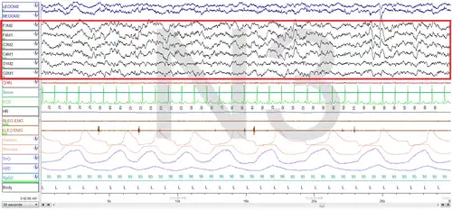 Stage 3 Sleep. EEG highlighted by red box.