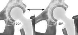Acetabular inclination is normally between 30 and 50°.[95] A larger angle increases the risk of dislocation.[16]