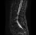 MRI lumbar spine with degeneration, post-hemilaminectomy L4-5 (sagittal FAST STIR)