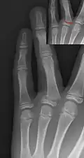 Salter–Harris II fracture of ring finger proximal phalanx.