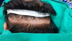 Scalp Micro pigmentation