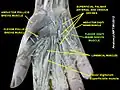 Flexor digiti minimi brevis muscle