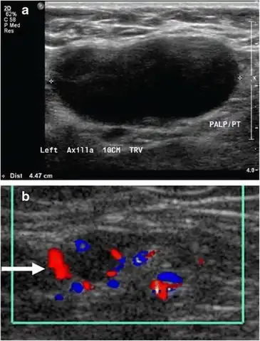 Medical ultrasonography of a soft tissue lump, showing signs of a suspected malignant lymph node:[15] - Doppler ultrasonography that shows hyperaemic blood flow in the hilum and central cortex and/or abnormal (non-hilar cortical) blood flow - Increased focal cortical thickness greater than 3&nbsp;mm - Absence of the fatty hilum