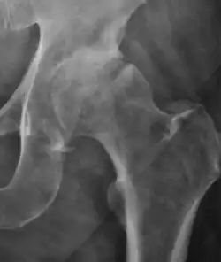 Hip in osteoarthritis