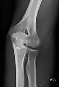 Left elbow by 30 degrees external oblique projection