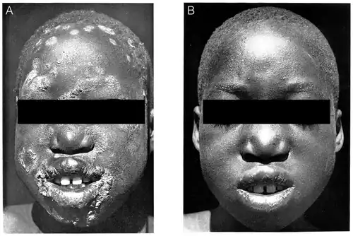 Before and two weeks after a single injection of benzathine penicillin, 1950s.